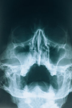 X-ray of the head. Real x-ray picture of a human skull at a doctor’s appointment.  Sinusitis and maxillary sinuses.