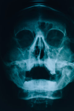 X-ray of the head. Real x-ray picture of a human skull at a doctor’s appointment.  Sinusitis and maxillary sinuses.