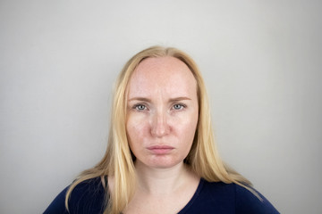 Oily and problem skin. Portrait of a blonde girl with acne, oily skin and pigmentation