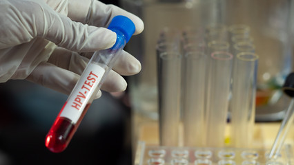 Doctor wearing blue gloves holding test tube,  In there, the blood that was examined for the HPV virus .