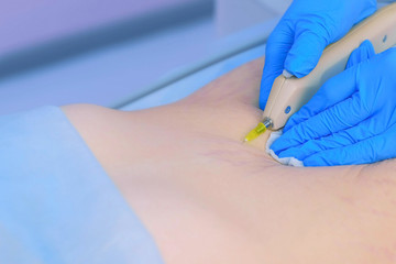 Doctor making injection of carbon dioxide on patient abdomen on carboxytherapy, tummy closeup. Cosmetologist woman using special apparatus. Treatment, cure and remove of skin tags and stretches.