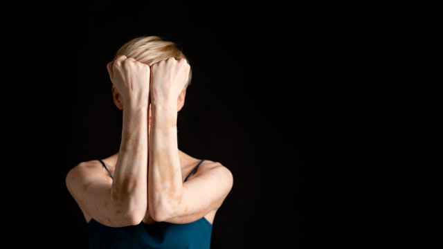 Woman with dermatology problem, covers face, panorama