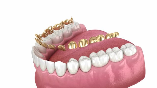 Lingual golden braces system. 3D animation concept of golden braces
