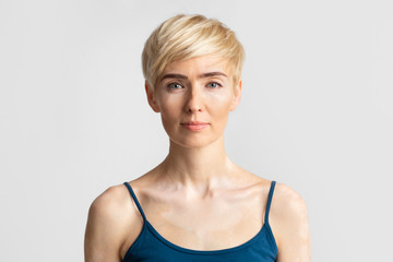 Fototapeta premium Portrait of woman with lack of pigment in skin