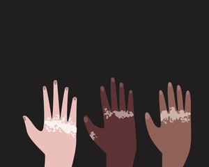 Hands with dermatological Vitiligo disease are raised up and place for text as a unity concept, flat vectorana glass art illustration with hands, vitiligo and copyspace on a black background