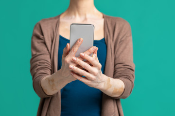 Bodipozitiv. Woman with vitiligo makes selfie, cropped