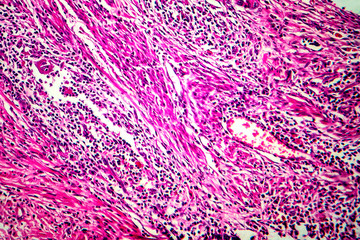 Squamous cell carcinoma of the uterus, light micrograph