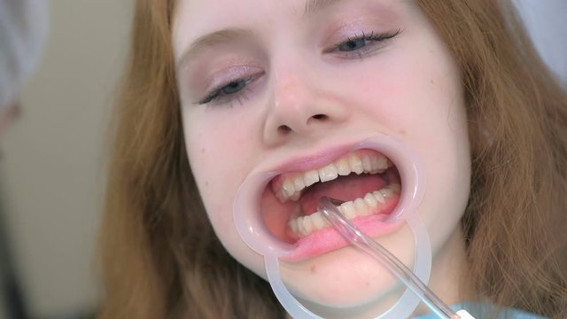 Orthodontist preparing woman teeth in dentistry before braces installing covering special gel using brush. Treatment and cure in dentistry. Portrait of girl with retractor in mouth. Correcting teeth.