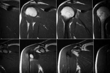 X-ray of the human shoulder joint