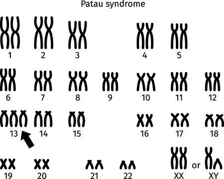 Scheme of Patau syndrome karyotype of human somatic cell 47XX+13 and 47XY+13