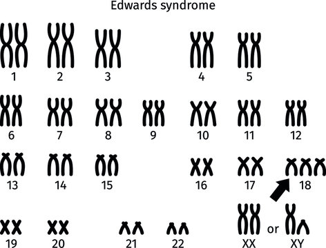 Scheme of Edwards syndrome karyotype of human somatic cell 47XX+18 and 47XY+18