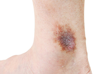 Naklejka premium Atopic dermatitis (AD), also known as atopic eczema, is a type of inflammation of the skin (dermatitis) at foot.