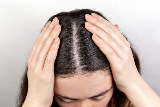 The woman parted her dark hair with her hands, showing dandruff. Close up. The view from the top. White background. The concept of dandruff and pediculosis