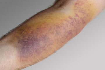 Männerarm mit Hämatom