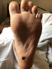 A foot wound