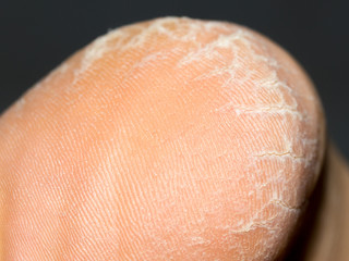 Fototapeta premium dry dehydrated skin on the heels of female legs