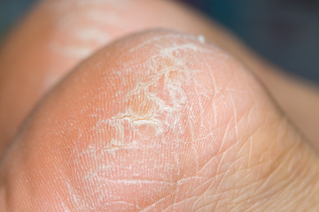 Fototapeta premium dry dehydrated skin on the heels of female legs