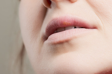 Obraz premium Female lips with herpes virus