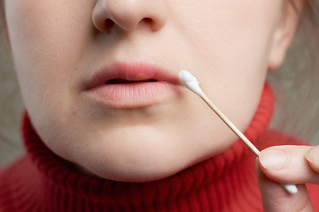 Obraz premium Woman uses cotton swab with ointment to treat herpes on her lip