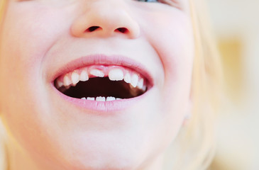 Kid with crooked teeth. Girl show her diastema teeth.