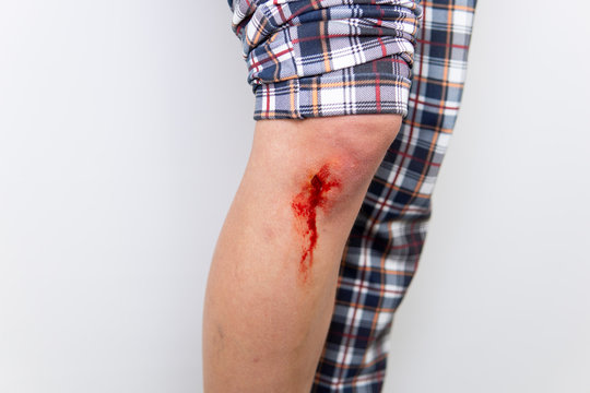 Beinverletzung Knie mit Blut