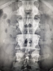 X-ray of the human spine