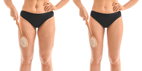 Woman with massage brush before and after anti-cellulite treatment on white background