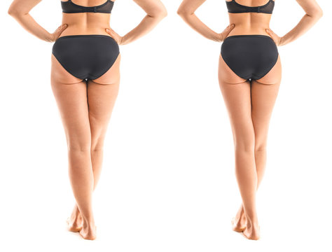 Love Handle Liposuction: Get Rid of Unwanted Flank Fat Fast