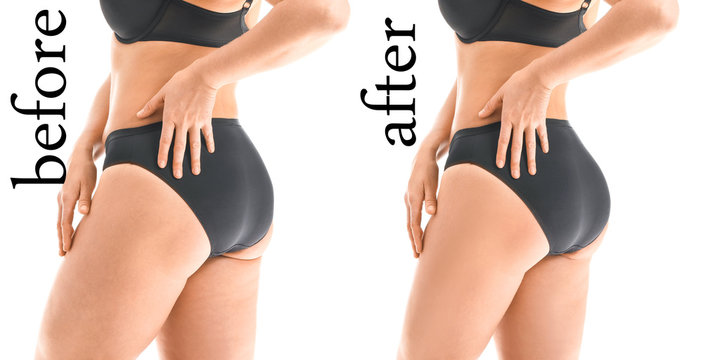 Real Vaser Liposuction Reviews: Pros, Cons, and Patient Satisfaction