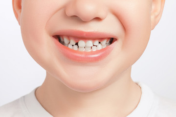 Closeup of child milk teeth with gaps between them. Diaeresis, diastema treatment concept. Dental...