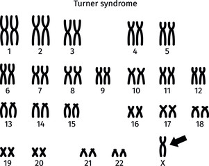 Scheme of Turner syndrome karyotype of human somatic cell 45X0 - obrazy, fototapety, plakaty