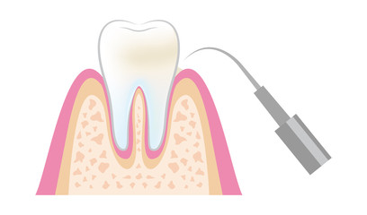 dental_pmtc_step03