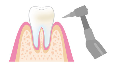 dental_pmtc_step06