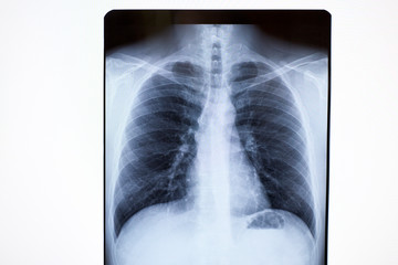 x-ray of lungs of a sick person