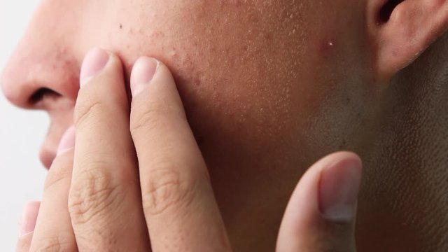 Close-up the side face of Asian teenage guy with acne and skin problems. Health and skin care concepts.