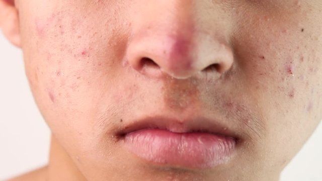 Close up face of Asian teenage guy with acne and problem skin. Skin care concept.