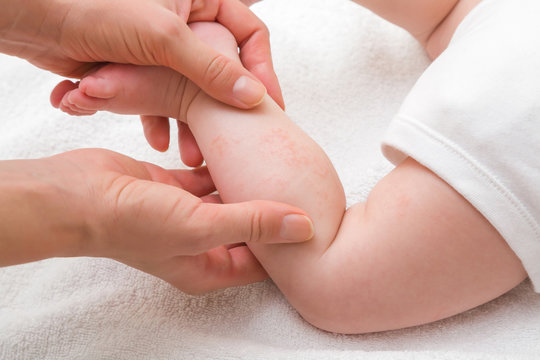 Woman hands holding infant leg. Red dry skin allergy from milk formula or other food. Closeup.