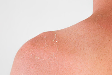 Fototapeta premium Peeled skin on young man shoulder from sun burn. Closeup. Isolated on light gray background. Back view.