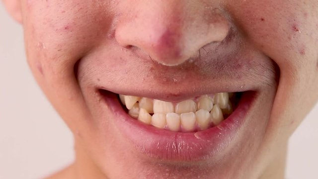 Close up face of Asian teenage guy with a problem of abnormal tooth structure. Health and oral care concepts.