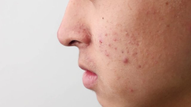 Close-up the side face of Asian teenage guy with acne and skin problems. Health and skin care concepts.