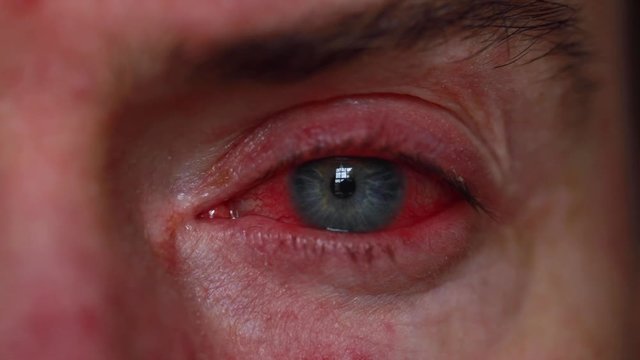 Close up of a severe bloodshot eye. Blepharitis, Conjunctivitis condition