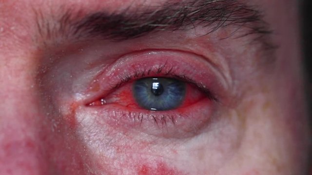 Close up of a severe bloodshot eye. Blepharitis, Conjunctivitis condition