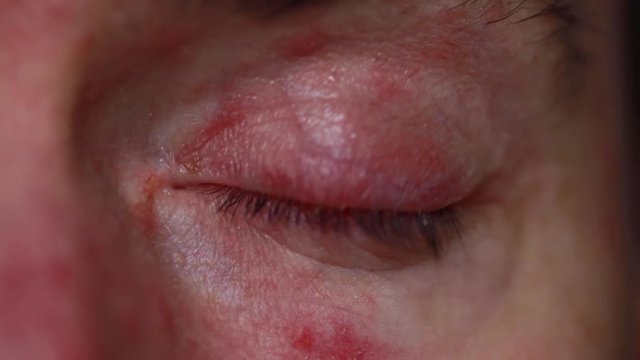 Close up of a severe bloodshot eye. Blepharitis, Conjunctivitis condition