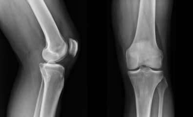 X-ray knee radiograph show state of injury