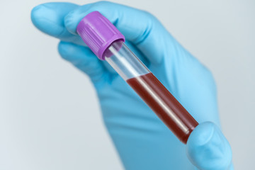 Female hands in medical blue gloves test tube with a close-up blood sample for research in a clinical laboratory. Concept of medicine, analyses