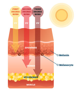 Sunburn skin damage anatomical cross section diagram