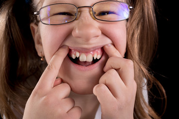 Little girl shows crooked teeth on a black background.