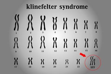 Karyotype of Klinefelter&rsquo;s or XXY usually in male is born with an extra X chromosome (XXY).