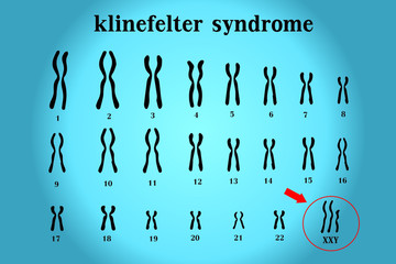 Karyotype of Klinefelter’s or XXY usually in male is born with an extra X chromosome (XXY).