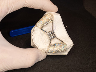 Rear tooth hyrax expander. Temporary frame appliance © rdonar